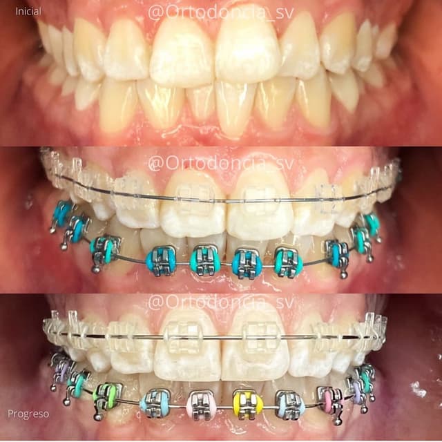 Brackets Estéticos (Cerámicos)