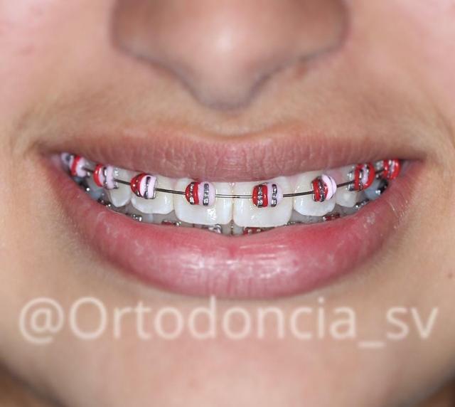 Brackets Metálicos